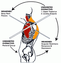 upper_crossed_syndrome1